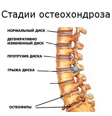 Остеохондроз шейного отдела позвоночника: симптомы и лечение, причины возникновения