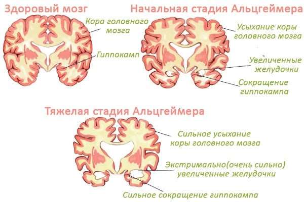 Болезнь Альцгеймера: что это такое, симптомы и признаки, причины возникновения и лечение